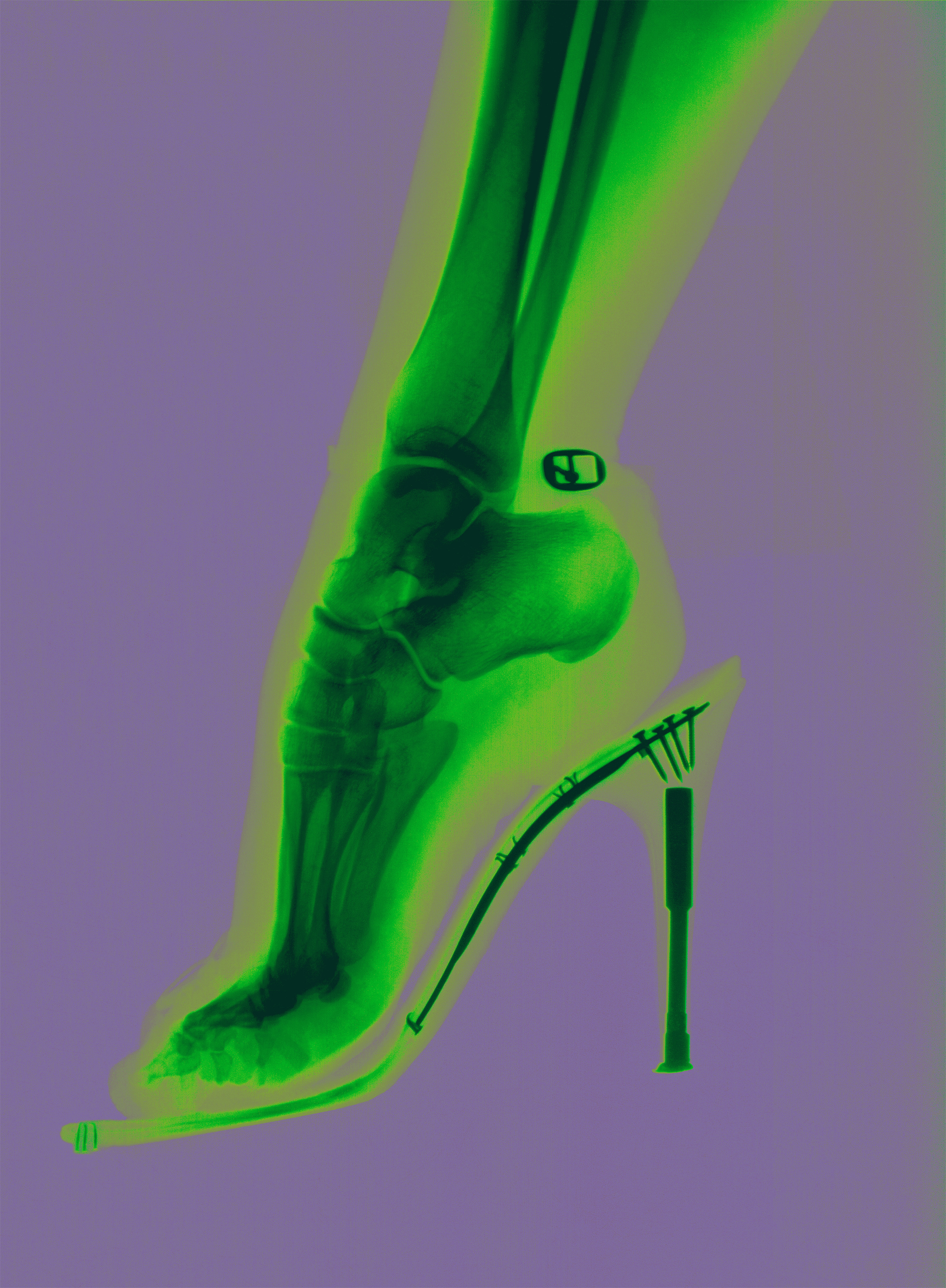 Horst Widmann, Le pied vert